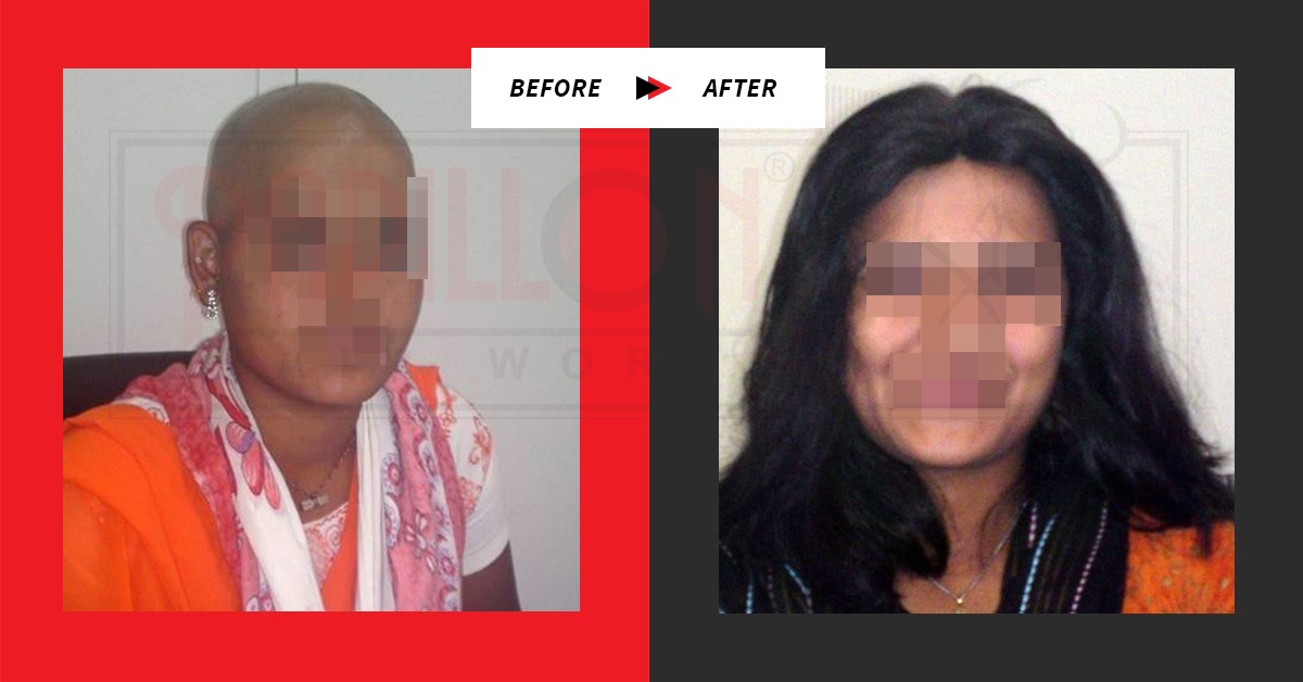 Before / After Testimonials : Hair Loss Treatment for Women