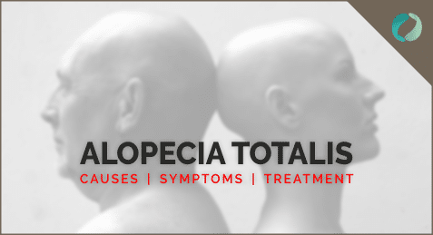 Alopecia Totalis: Causes, Symptoms And Treatment