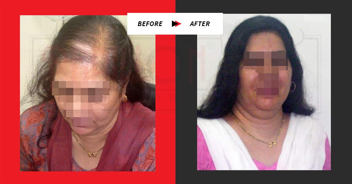 Hair Loss Treatment for Female Testimonials Before / After