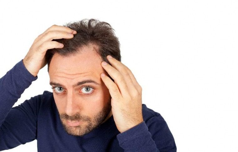 Causes of Male Baldness & treatment – Papillon Hair World
